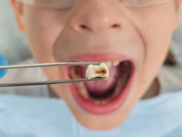 Best Emergency Tooth Extraction in Lancaster, PA